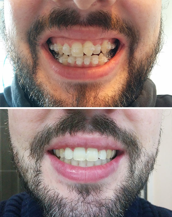 Transformations incroyables avant et après des personnes qui portaient
