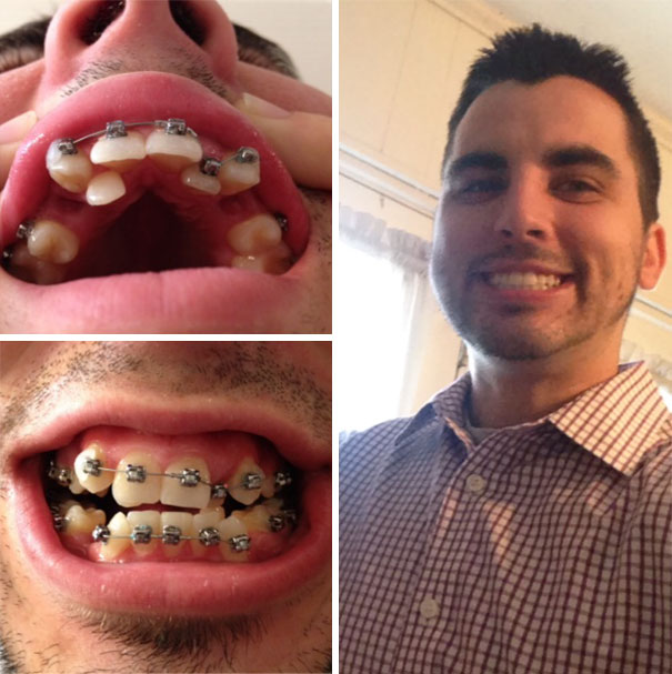 dental-braces-before-after-102-592299e625d83__605