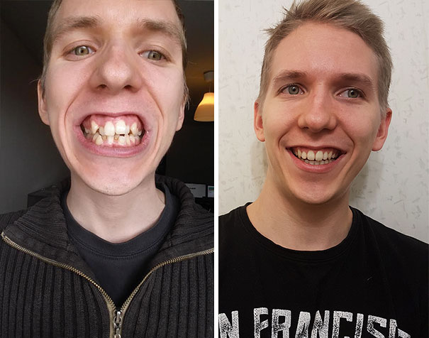 dental-braces-before-after-103-59229a9f86bdd__605