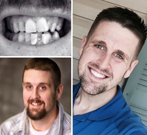 dental-braces-before-after-201-5927ddc8478b4__605