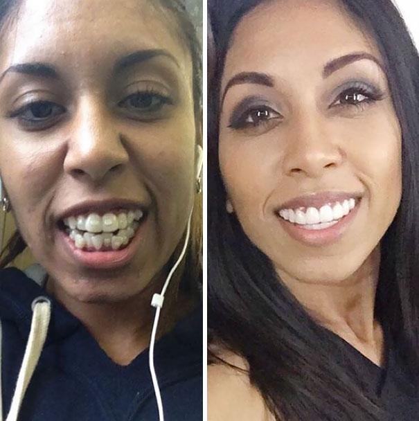 dental-braces-before-after-141-59253d6290cd1__605