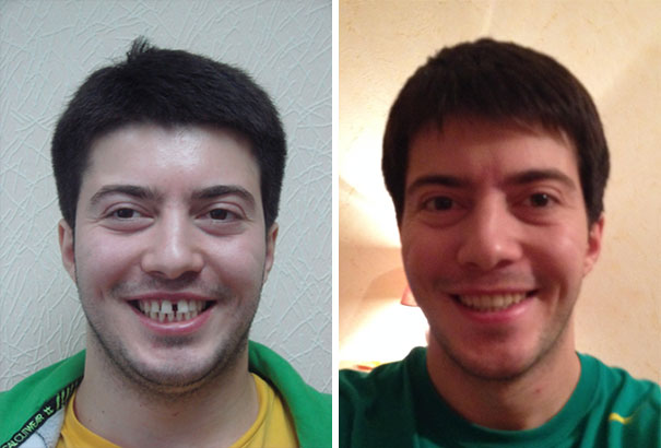 dental-braces-before-after-122-5922e487d48e5__605