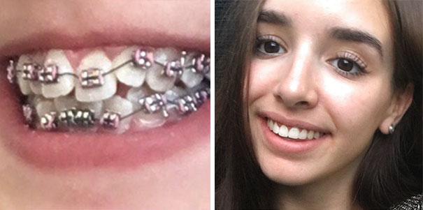 dental-braces-before-after-110-5922ab8eb9bea__605
