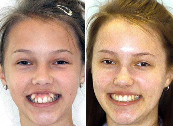 dental-braces-before-after-210-5927f0f4064e3__605