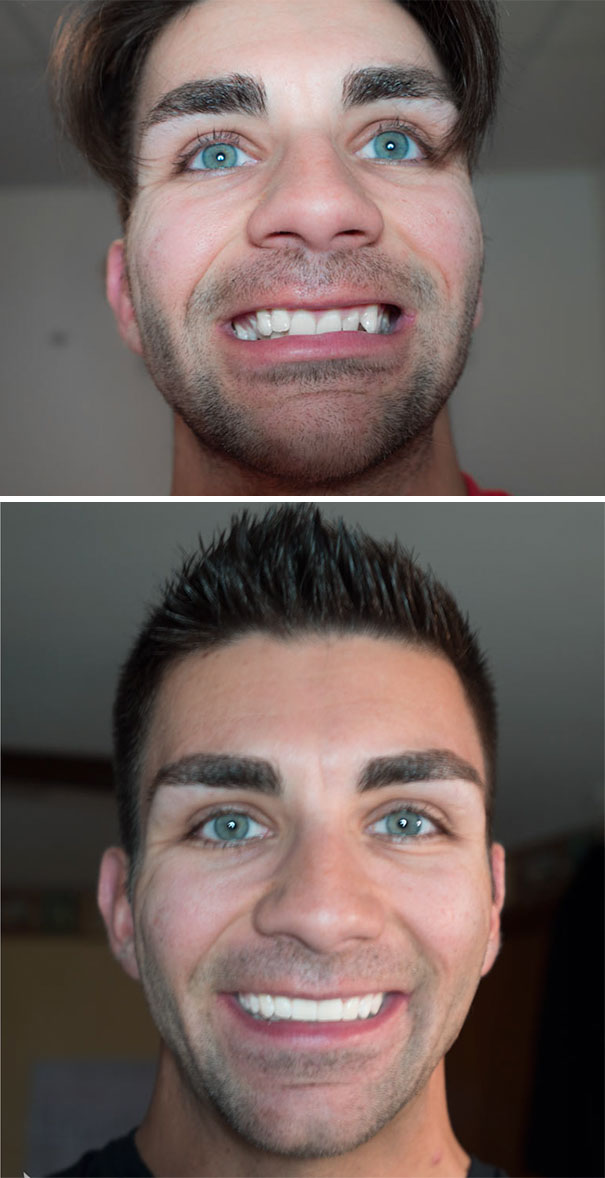 dental-braces-before-after-126-5922eaabe8024__605