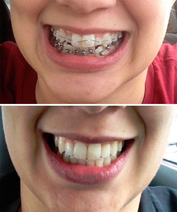 dental-braces-before-after-123-5922e65ccfc7b__605