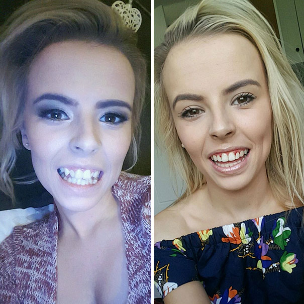 dental-braces-before-after-50-592578a168764__605