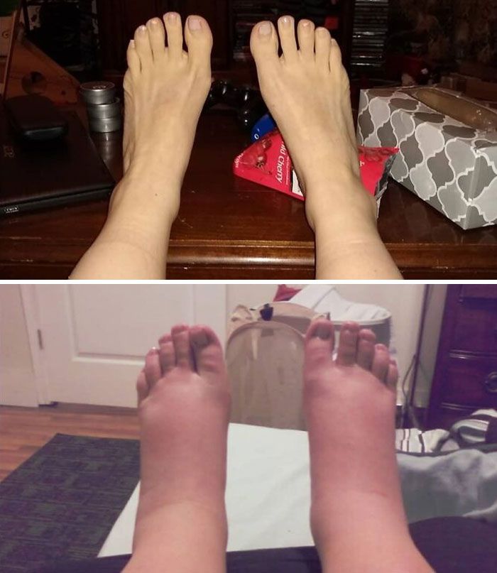 mes pieds maintenant (en haut) vs mes pieds lorsque j’étais enceinte de 8+ mois avec les jumeaux (en bas)