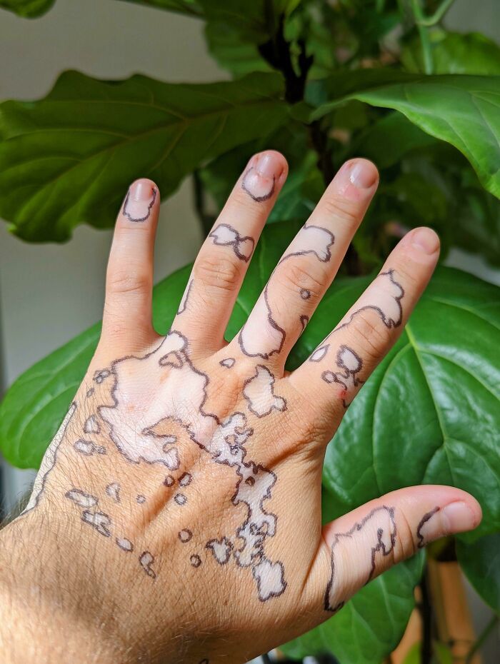 j’ai tracé autour de mes taches de vitiligo