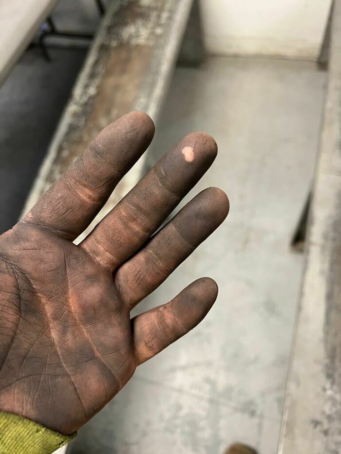 cette brûlure sur mon doigt ne se salit pas