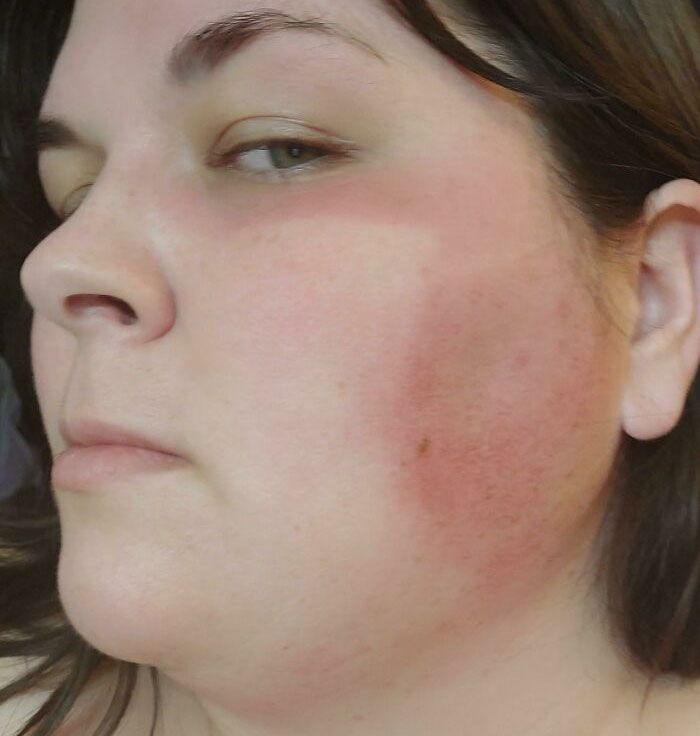 Je travaille dans une clinique de vaccination en plein air. Je n’ai pas pensé à la crème solaire… maintenant j’ai un coup de soleil en forme de masque, mais seulement sur la moitié de mon visage.