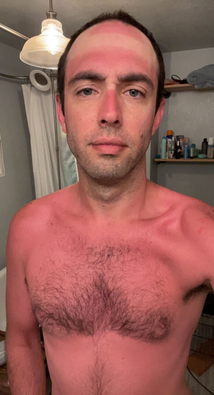 Comme une idiote, j’ai choisi de ne pas mettre de crème solaire.