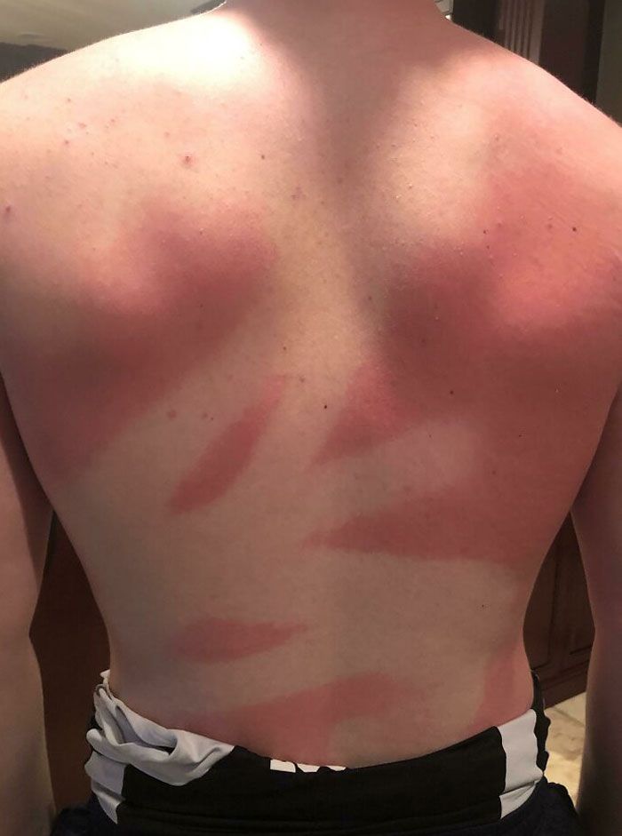 J’ai demandé à mon amie de vaporiser de la crème solaire sur mon dos… pas la couche la plus uniforme.