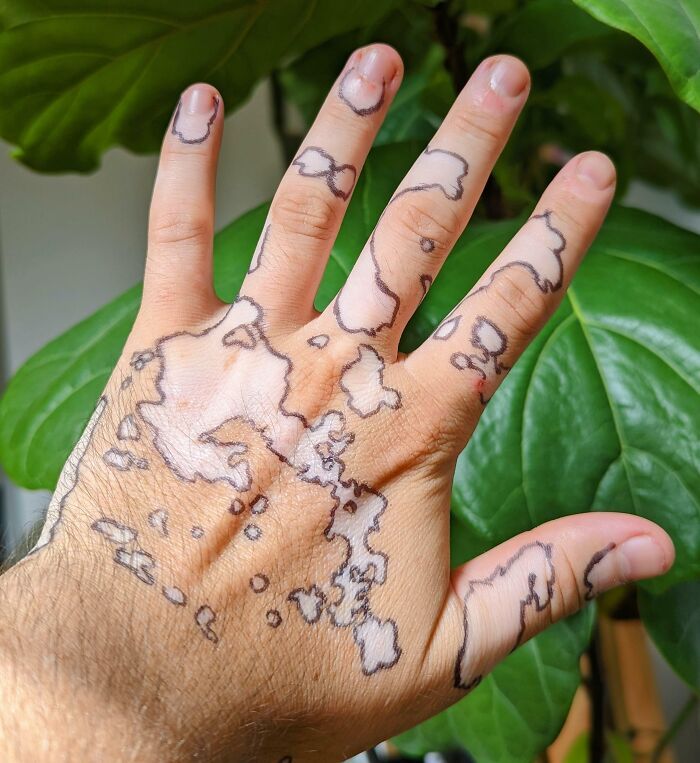 j’ai tracé autour de mes taches de vitiligo