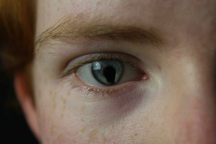 une photo de mes yeux prise par un ami il y a quelque temps, qui montre ma maladie oculaire rare, le double colobome (de l’iris et de la rétine). je l’ai dans les deux yeux.