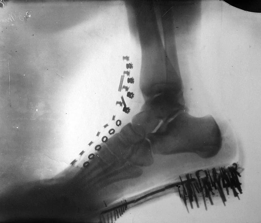 la radiographie du pied de nikola tesla prise par lui-même sur une machine qu’il a conçue (1896)