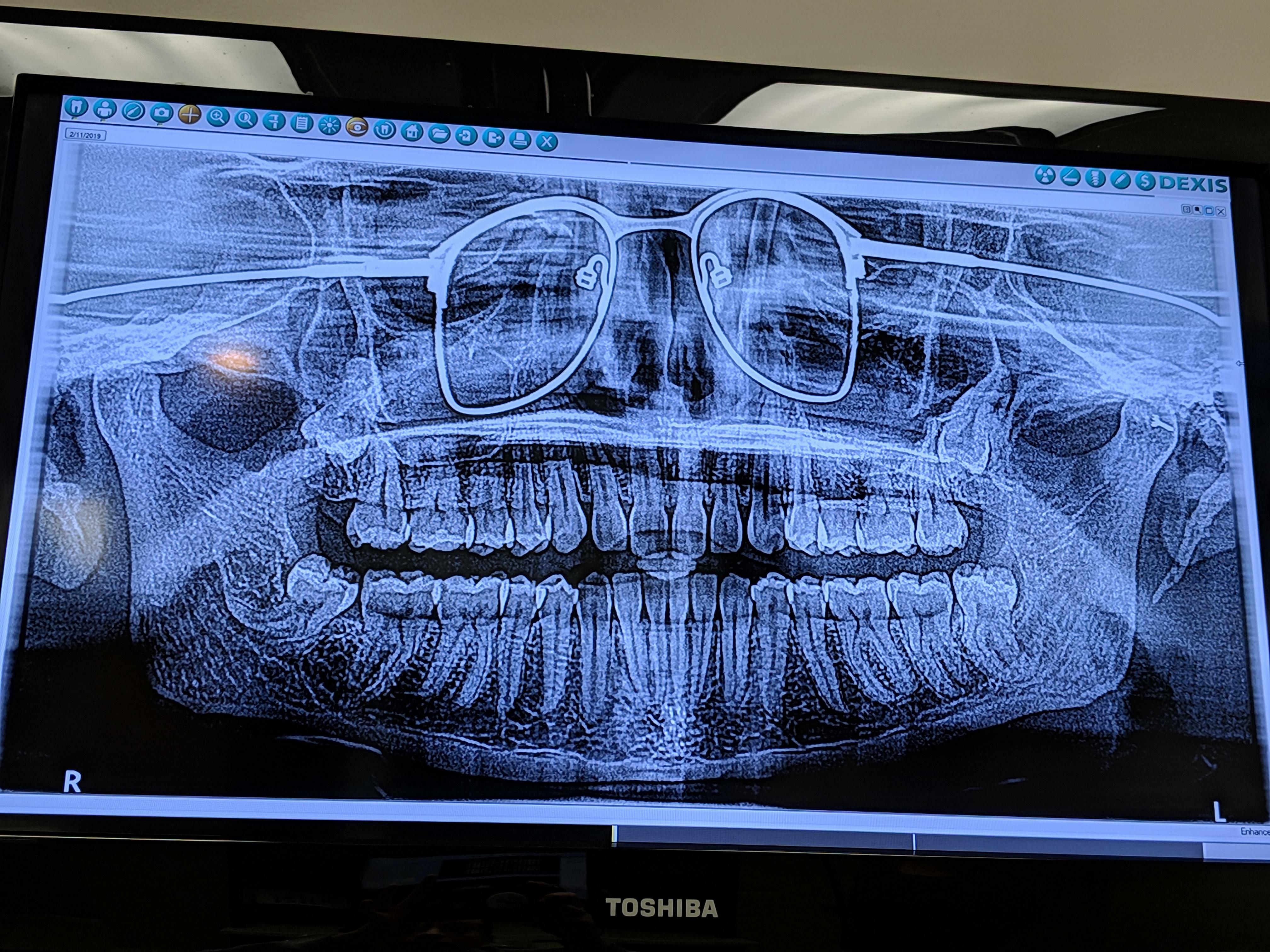 J'ai eu une radiographie panoramique de mes dents l'autre jour. Le dentiste a oublié de me faire enlever mes lunettes.