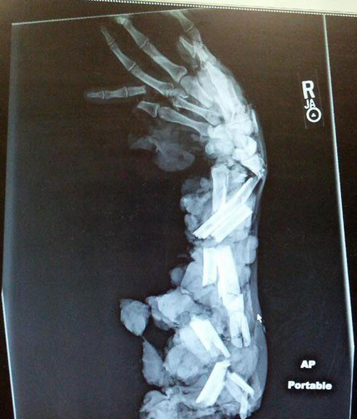 une radiographie du bras d’un homme qui a été écrasé par un hachoir à viande.