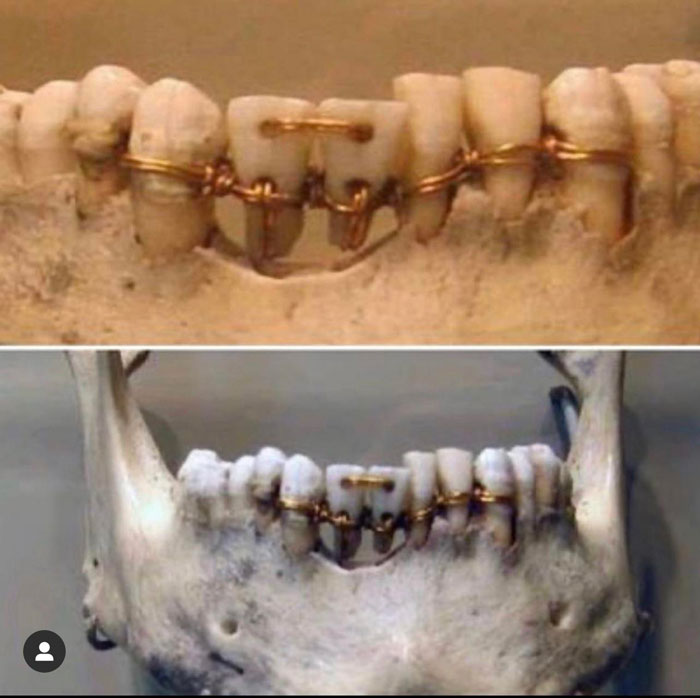 ancien travail dentaire égyptien