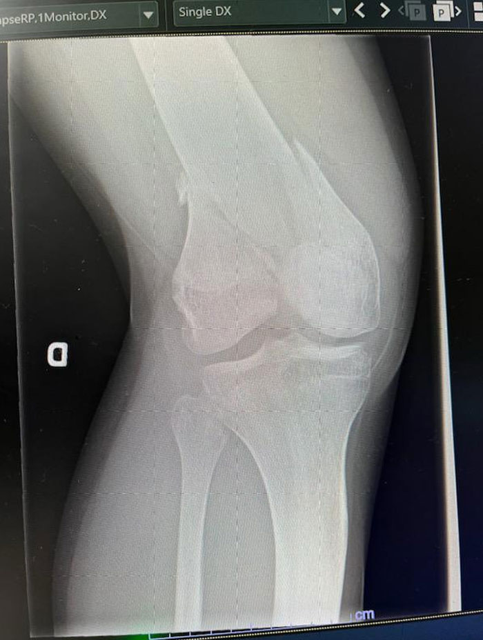 radiographie de ma fracture fémorale (oui, l’os est coupé en deux)