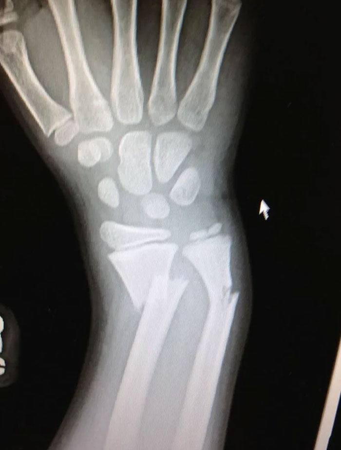 radiographie de mon bras cassé quand j’étais enfant