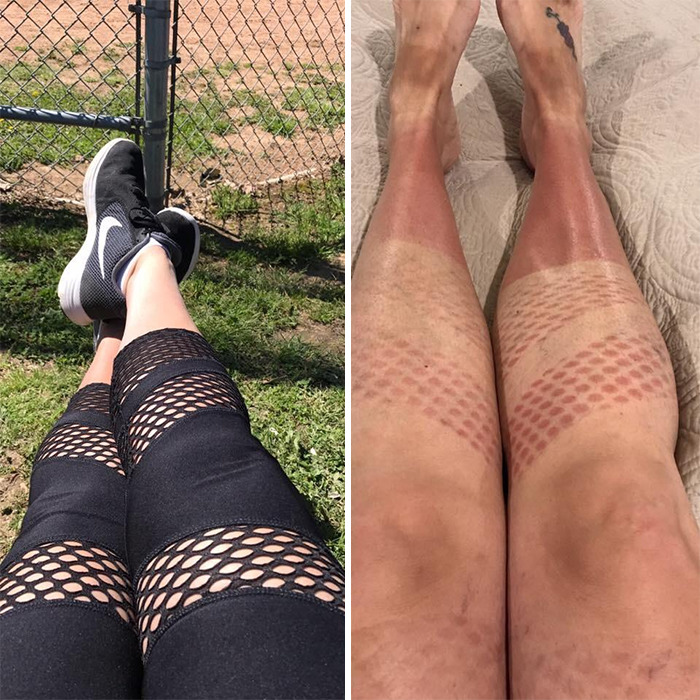 When The Sun’s Out And You Don’t Think It Through