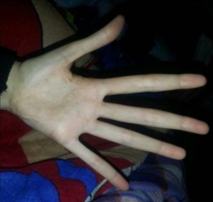 Here Are My Marfan’s Syndrome Hands