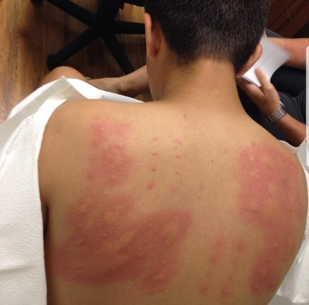 Allergic To Almost Everything On The Allergy Skin Test. Some Of It Was So Swollen The Doctor Could Barely Tell Which Was Which