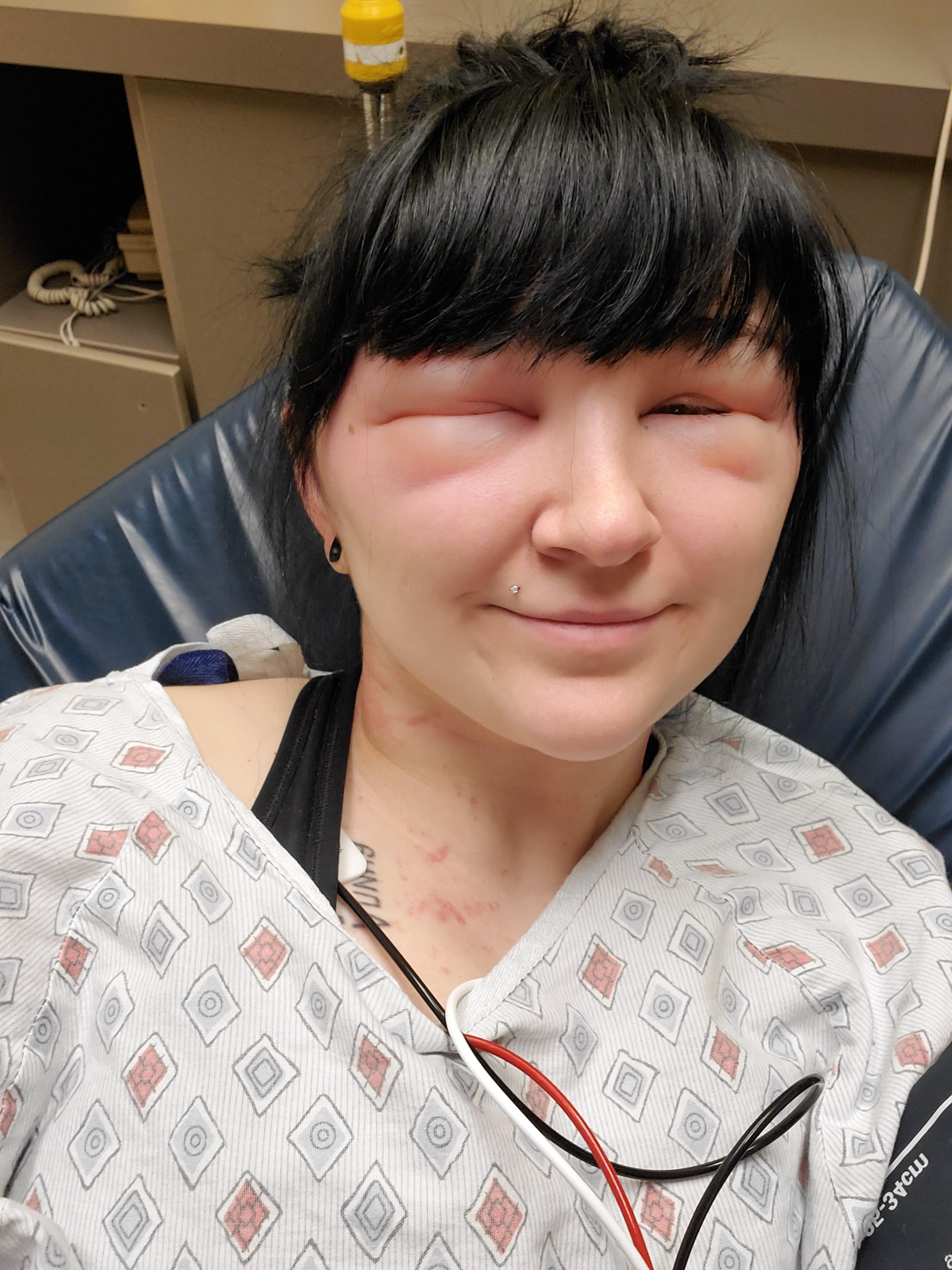 Guess Who's Severely Allergic To Hair Dye? This Girl