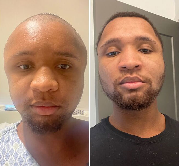 J’ai subi une opération de reconstruction faciale il y a deux mois. On m’a appelé megamind, ken griffey jr, jimmy nuetron, etc. 8 semaines plus tard, je me sens beaucoup plus confiante dans mon apparence.