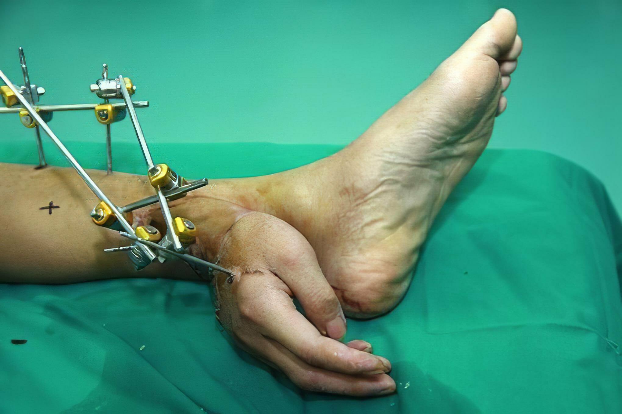 Les médecins ont maintenu en vie la main de l’ouvrier chinois Xie Wei en la cousant à sa cheville gauche