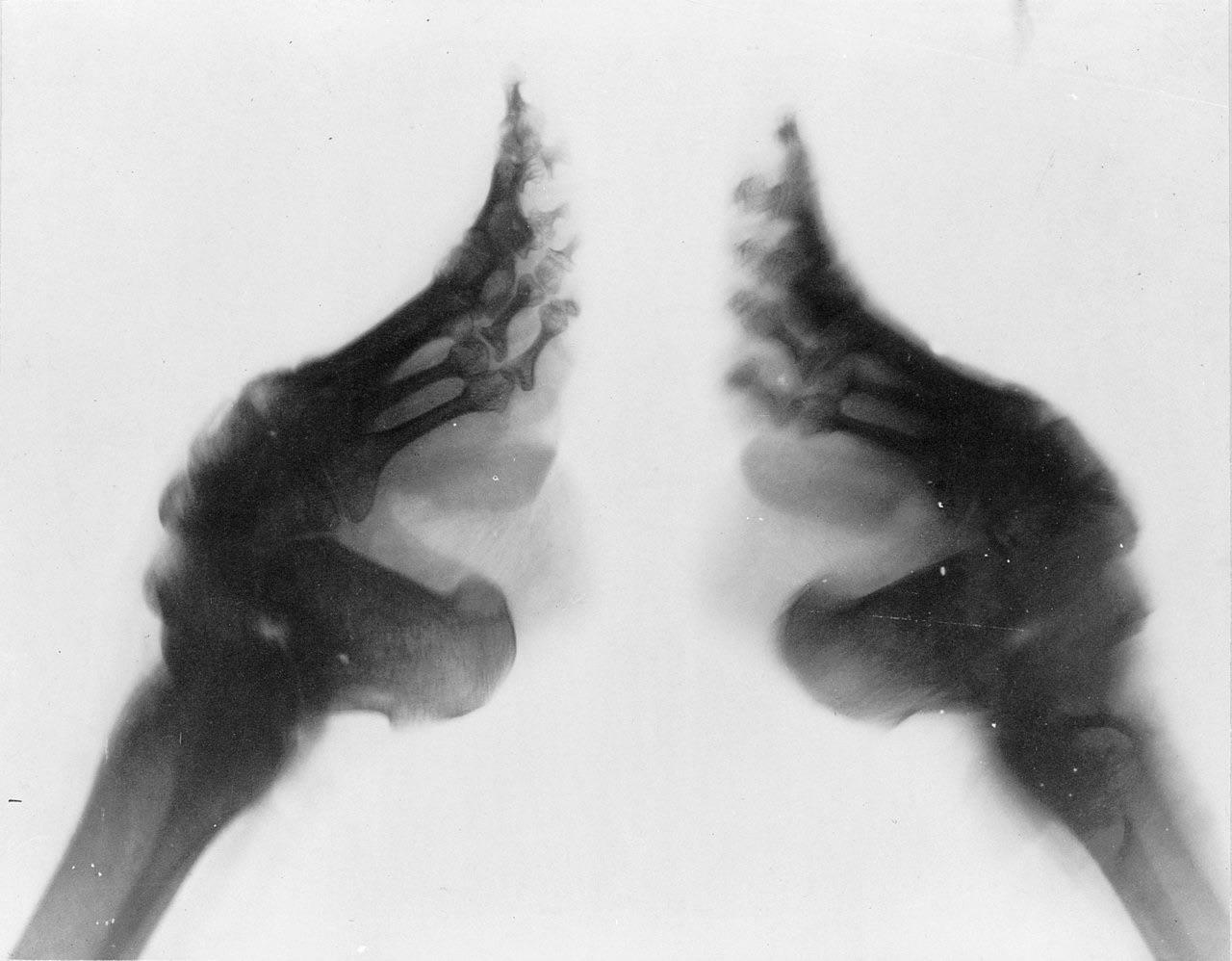 Radiographie d’une femme chinoise qui a subi un bandage des pieds